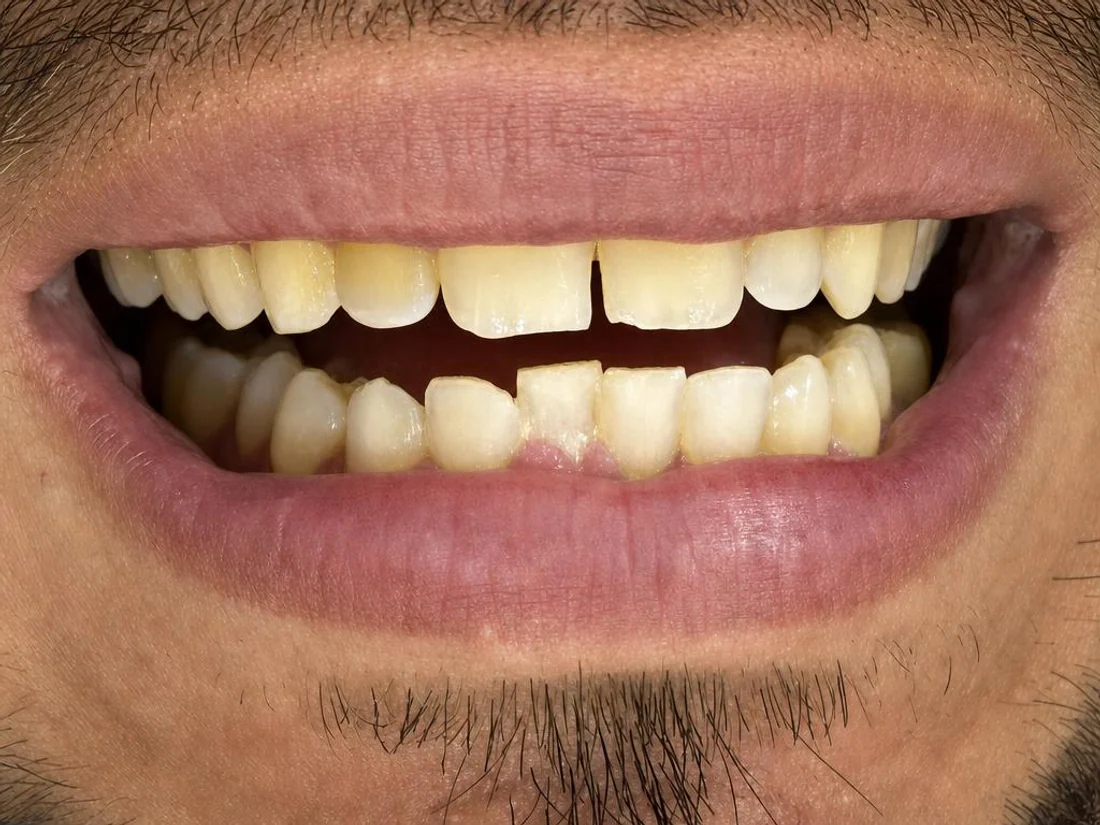 Sonrisa antes del tratamiento